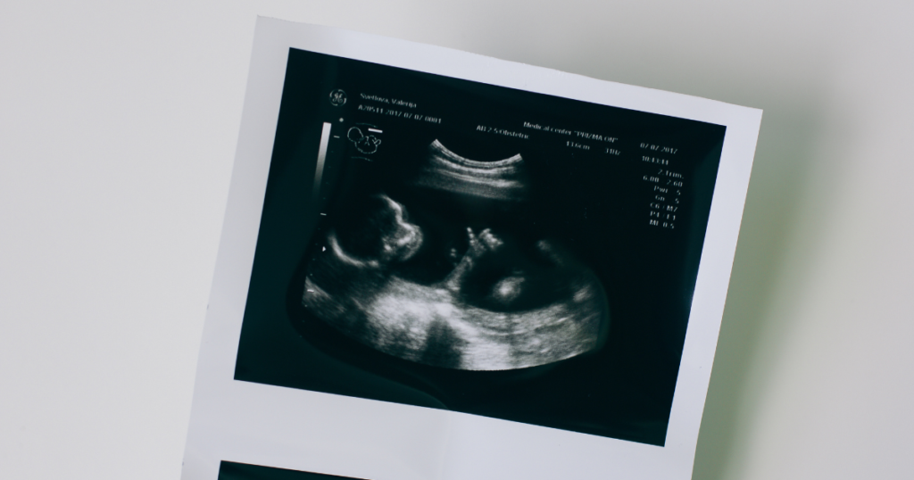 Three reasons to get an ultrasound before taking the abortion pill
